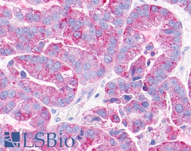 Anti-GPRC5C antibody IHC of human Ovary, Carcinoma. Immunohistochemistry of formalin-fixed, paraffin-embedded tissue after heat-induced antigen retrieval.