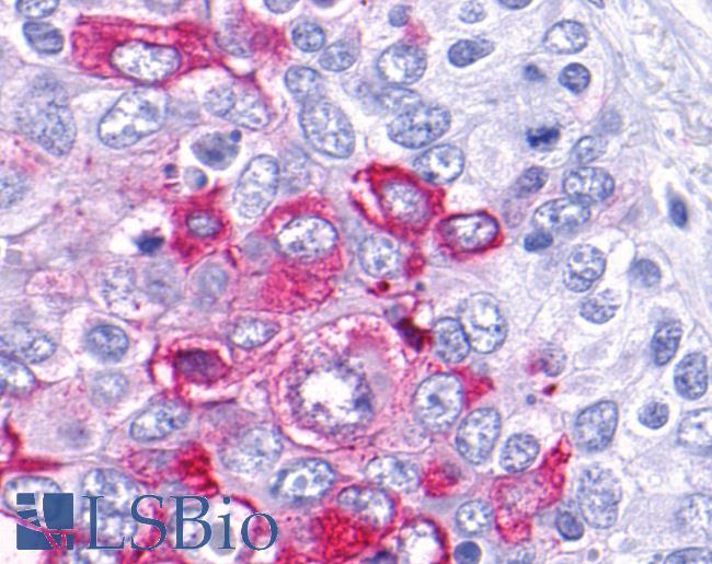 Anti-GPRC5C antibody IHC of human Lung, Non-Small Cell Carcinoma. Immunohistochemistry of formalin-fixed, paraffin-embedded tissue after heat-induced antigen retrieval.