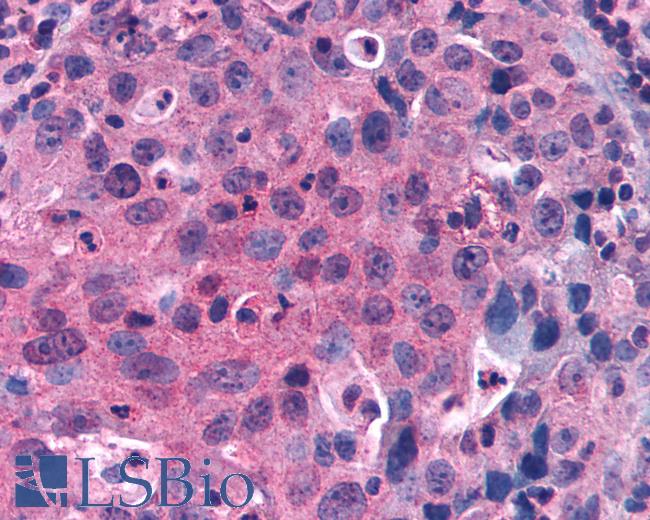 Anti-GPRC5C antibody IHC of human Lung, Non-Small Cell Carcinoma. Immunohistochemistry of formalin-fixed, paraffin-embedded tissue after heat-induced antigen retrieval.