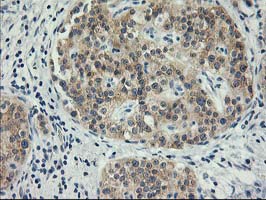IHC of paraffin-embedded Carcinoma of Human pancreas tissue using anti-ITFG2 mouse monoclonal antibody.