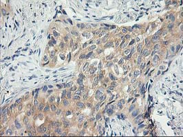 IHC of paraffin-embedded Carcinoma of Human lung tissue using anti-ITFG2 mouse monoclonal antibody.