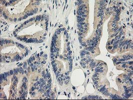 IHC of paraffin-embedded Adenocarcinoma of Human colon tissue using anti-ITFG2 mouse monoclonal antibody.