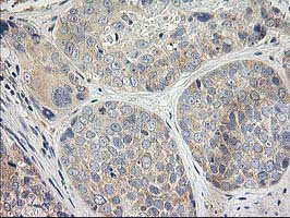 IHC of paraffin-embedded Adenocarcinoma of Human breast tissue using anti-ITFG2 mouse monoclonal antibody.