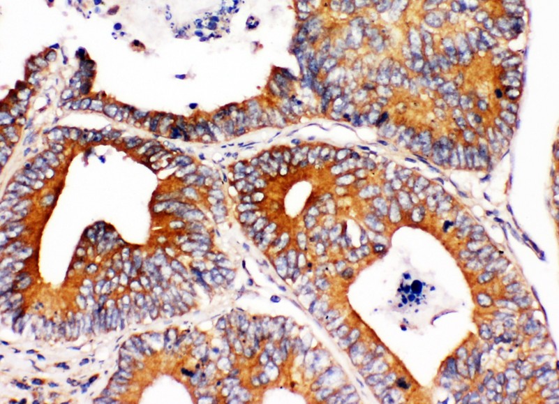 Integrin alpha 1 antibody IHC-paraffin: Human Intestinal Cancer Tissue.