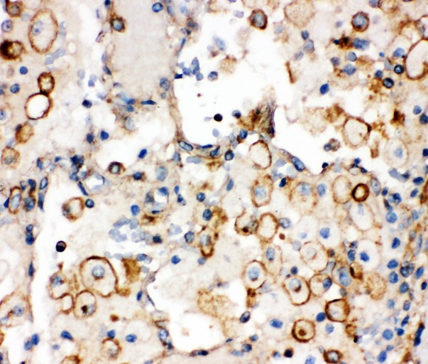 Integrin alpha 1 antibody IHC-paraffin: Human Lung Cancer Tissue.