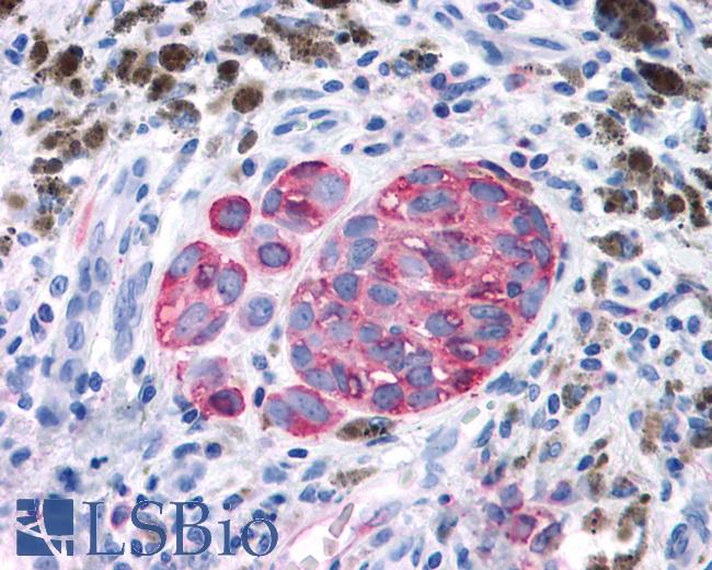 Anti-GPRC6A antibody IHC of human Skin, Melanoma. Immunohistochemistry of formalin-fixed, paraffin-embedded tissue after heat-induced antigen retrieval.