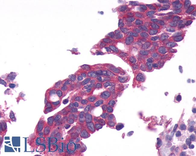 Anti-GPRC6A antibody IHC of human Ovary, Carcinoma. Immunohistochemistry of formalin-fixed, paraffin-embedded tissue after heat-induced antigen retrieval.