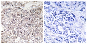 IHC of paraffin-embedded human breast carcinoma, using GPRIN3 Antibody. The picture on the right is treated with the synthesized peptide.