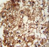 CD11b antibody immunohistochemistry of formalin-fixed and paraffin-embedded human hepatocarcinoma followed by peroxidase-conjugated secondary antibody and DAB staining.