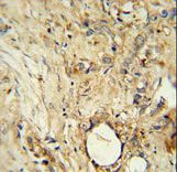 ITIH5 Antibody immunohistochemistry of formalin-fixed and paraffin-embedded human breast carcinoma followed by peroxidase-conjugated secondary antibody and DAB staining.