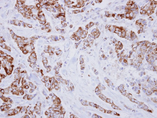 IHC of paraffin-embedded Breast ca using IVD antibody at 1:250 dilution.
