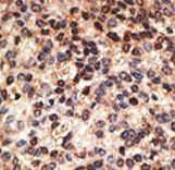 Formalin-fixed and paraffin-embedded human cancer tissue reacted with the primary antibody, which was peroxidase-conjugated to the secondary antibody, followed by DAB staining. This data demonstrates the use of this antibody for immunohistochemistry; clinical relevance has not been evaluated. BC = breast carcinoma; HC = hepatocarcinoma.