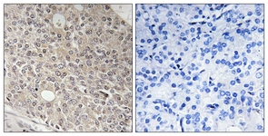 IHC of paraffin-embedded human prostate carcinoma tissue, using AMOTL1 Antibody. The picture on the right is treated with the synthesized peptide.