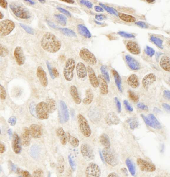 Detection of Human JHDM1A Immunohistochemistry. Sample: FFPE section of human breast carcinoma. Antibody: Affinity purified rabbit anti-JHDM1A used at a dilution of 1:250.