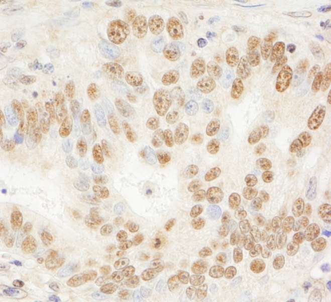 Detection of Human JHDM1A by Immunohistochemistry. Sample: FFPE section of human stomach carcinoma. Antibody: Affinity purified rabbit anti-JHDM1A used at a dilution of 1:200 (1 ug/ml). Detection: DAB.