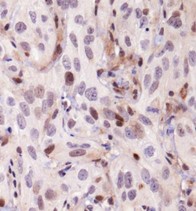 Immunohistochemistry: KDM2A/FBXL11 Antibody - IHC of KDM2A / FBXL11 in human kidney cancer xenograft using DAB with hematoxylin counterstain.