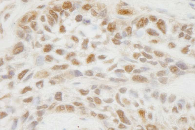 Detection of Human JMJD1C by Immunohistochemistry. Sample: FFPE section of human laryngeal squamous cell carcinoma. Antibody: Affinity purified rabbit anti-JMJD1C used at a dilution of 1:100.