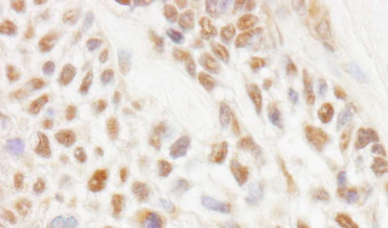 Detection of Human JMJD1C by Immunohistochemistry. Sample: FFPE section of human laryngeal squamous cell carcinoma. Antibody: Affinity purified rabbit anti-JMJD1C used at a dilution of 1:1000 (1 ug/ml). Detection: DAB.