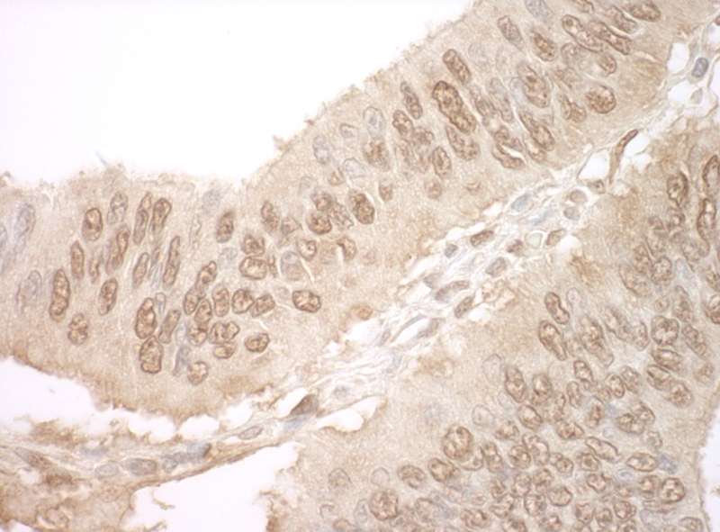 Detection of Human JMY by Immunohistochemistry. Sample: FFPE section of human colon carcinoma. Antibody: Affinity purified rabbit anti-JMY used at a dilution of 1:250.