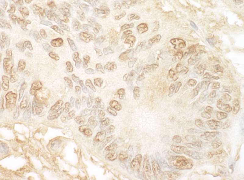 Detection of Human JMY by Immunohistochemistry. Sample: FFPE section of human colon carcinoma. Antibody: Affinity purified rabbit anti-JMY used at a dilution of 1:1000 (1 Detection: DAB.