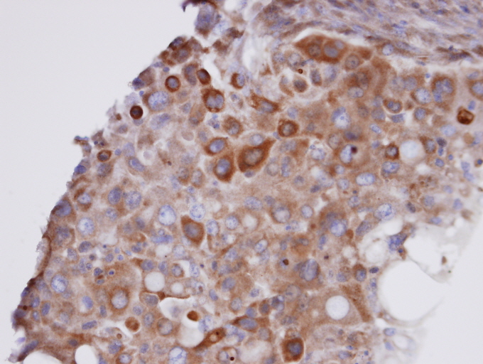 IHC of paraffin-embedded H441 xenograft using GPX7 antibody at 1:100 dilution.