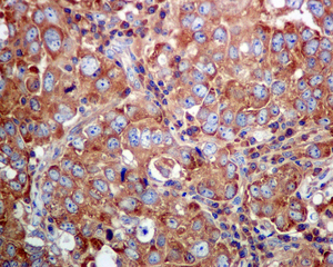 IHC of paraffin-embedded human breast carcinoma tissue using anti-KARS antibody.
