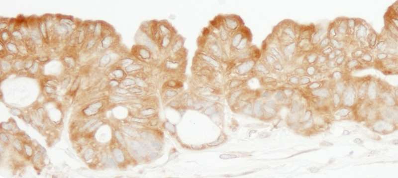 Detection of Human KARS by Immunohistochemistry. Sample: FFPE section of human ovarian carcinoma. Antibody: Affinity purified rabbit anti-KARS used at a dilution of 1:200 (1 Detection: DAB.