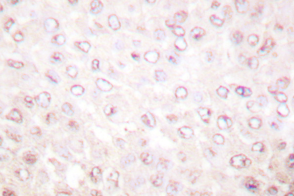 IHC of PCAF (F820) pAb in paraffin-embedded human breast carcinoma tissue.