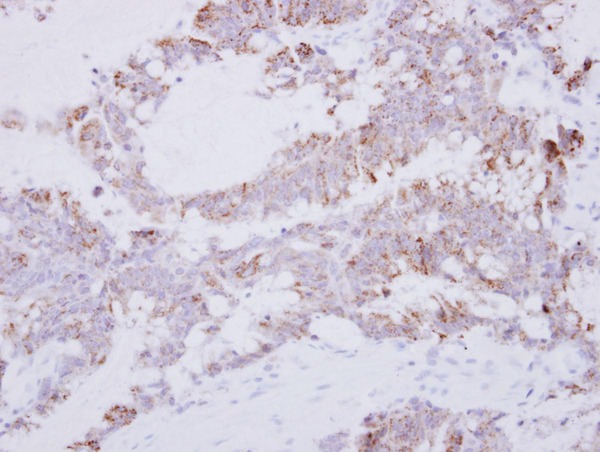 IHC of paraffin-embedded Colon ca using GRAP2 antibody at 1:500 dilution.