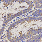 Immunohistochemistry of paraffin-embedded human rectal cancer using KCNE1 antibody at dilution of 1:200 (x400 lens)