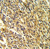 Formalin-fixed and paraffin-embedded human lung carcinoma reacted with KCNJ2 Antibody , which was peroxidase-conjugated to the secondary antibody, followed by DAB staining. This data demonstrates the use of this antibody for immunohistochemistry; clinical relevance has not been evaluated.