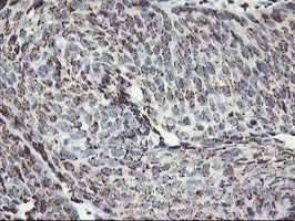 IHC of paraffin-embedded Carcinoma of Human bladder tissue using anti-KCNJ3 mouse monoclonal antibody.