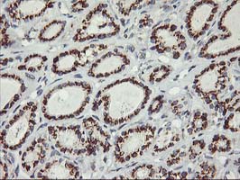 IHC of paraffin-embedded Carcinoma of Human thyroid tissue using anti-KCNJ3 mouse monoclonal antibody.