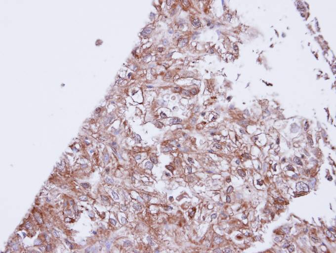 IHC of paraffin-embedded DU145 xenograft using GIRK1 antibody at 1:100 dilution.