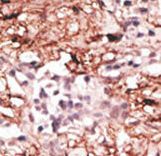 Formalin-fixed and paraffin-embedded human cancer tissue reacted with the primary antibody, which was peroxidase-conjugated to the secondary antibody, followed by DAB staining. This data demonstrates the use of this antibody for immunohistochemistry; clinical relevance has not been evaluated. BC = breast carcinoma; HC = hepatocarcinoma.