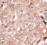 Formalin-fixed and paraffin-embedded human cancer tissue reacted with the primary antibody, which was peroxidase-conjugated to the secondary antibody, followed by DAB staining. This data demonstrates the use of this antibody for immunohistochemistry; clinical relevance has not been evaluated. BC = breast carcinoma; HC = hepatocarcinoma.