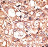 Formalin-fixed and paraffin-embedded human cancer tissue reacted with the primary antibody, which was peroxidase-conjugated to the secondary antibody, followed by DAB staining. This data demonstrates the use of this antibody for immunohistochemistry; clinical relevance has not been evaluated. BC = breast carcinoma; HC = hepatocarcinoma.