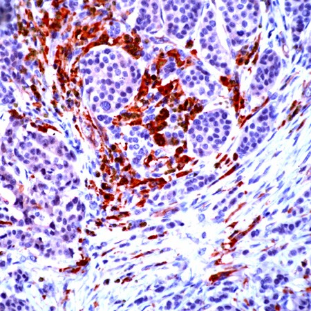 Human breast ca stained with Anti-NCK2