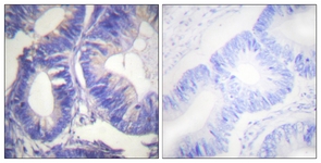 IHC of paraffin-embedded human colon carcinoma tissue, using NCK2 Antibody. The picture on the right is treated with the synthesized peptide.