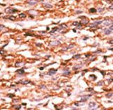 Formalin-fixed and paraffin-embedded human cancer tissue reacted with the primary antibody, which was peroxidase-conjugated to the secondary antibody, followed by AEC staining. This data demonstrates the use of this antibody for immunohistochemistry; clinical relevance has not been evaluated. BC = breast carcinoma; HC = hepatocarcinoma.