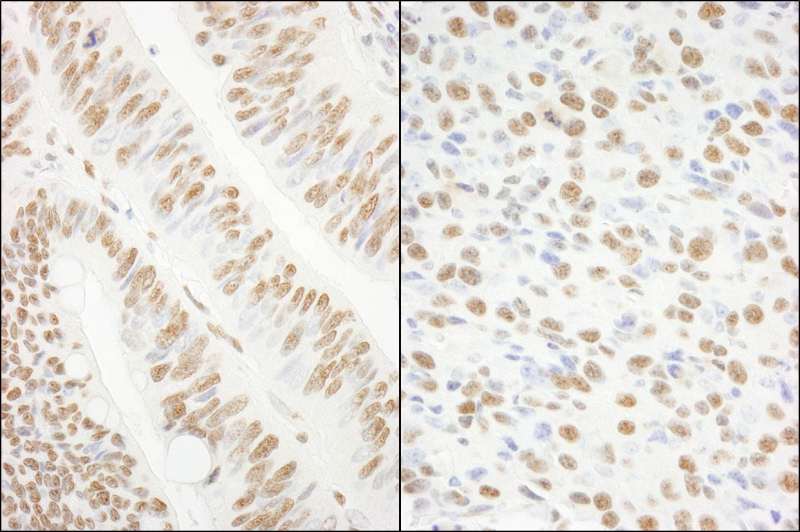Detection of Human and Mouse KSRP by Immunohistochemistry. Sample: FFPE section of human colon carcinoma (left) and mouse squamous cell carcinoma (right). Antibody: Affinity purified rabbit anti-KSRP used at a dilution of 1:1000 (0.2 Detection: DAB.