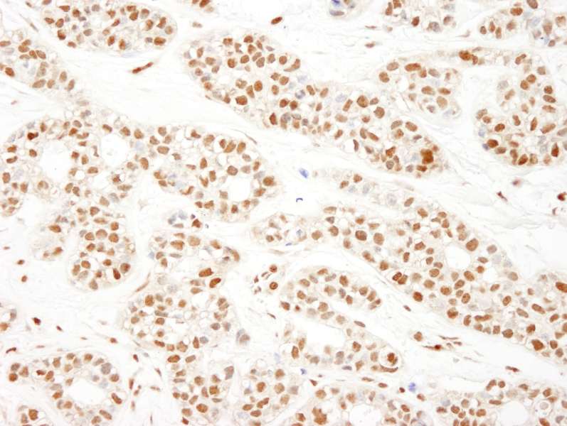 Detection of Human KSRP by Immunohistochemistry. Sample: FFPE section of human breast carcinoma. Antibody: Affinity purified rabbit anti-KSRP used at a dilution of 1:1000 (1 Detection: DAB.