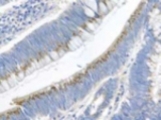 Detection of CKTSF1B1 in human colon cancer tissue using antibody.