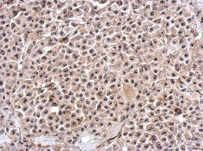 IHC of paraffin-embedded HBL435 xenograft, using KIAA0020 antibody at 1:500 dilution.