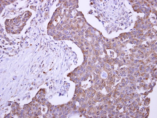 Malectin antibody detects KIAA0152 protein at cytosol on Colon Carcinoma by immunohistochemical analysis. Sample: Paraffin-embedded Colon Carcinoma. Malectin antibody dilution:1:500.