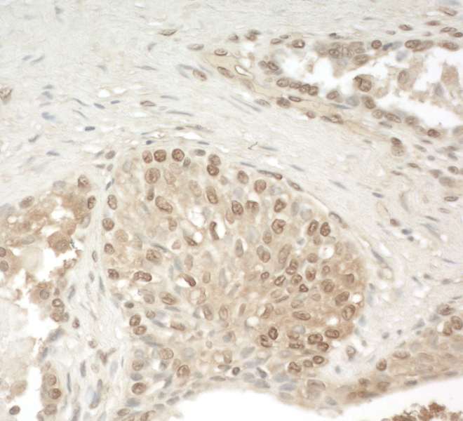 Detection of Human ZCCHC11 by Immunohistochemistry. Sample: FFPE section of human prostate carcinoma. Antibody: Affinity purified rabbit anti-ZCCHC11 used at a dilution of 1:250.