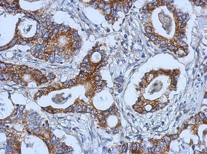 IHC of paraffin-embedded Gastric ca, using KIAA0196 antibody at 1:500 dilution.