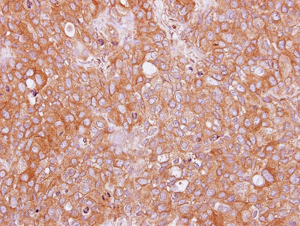 IHC of paraffin-embedded BT474 xenograft using AHCYL2 antibody at 1:100 dilution.