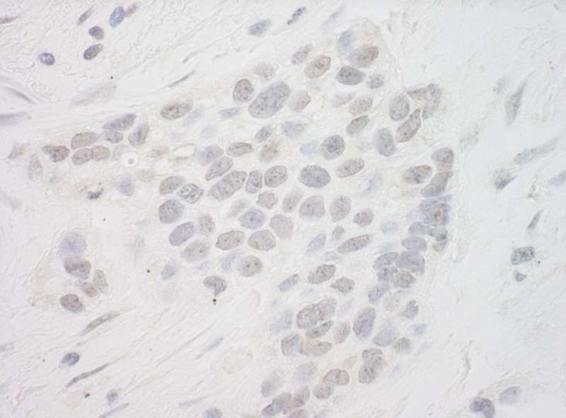 Detection of Human TMEM131L by Immunohistochemistry. Sample: FFPE section of human breast carcinoma. Antibody: Affinity purified rabbit anti-TMEM131L used at a dilution of 1:250.