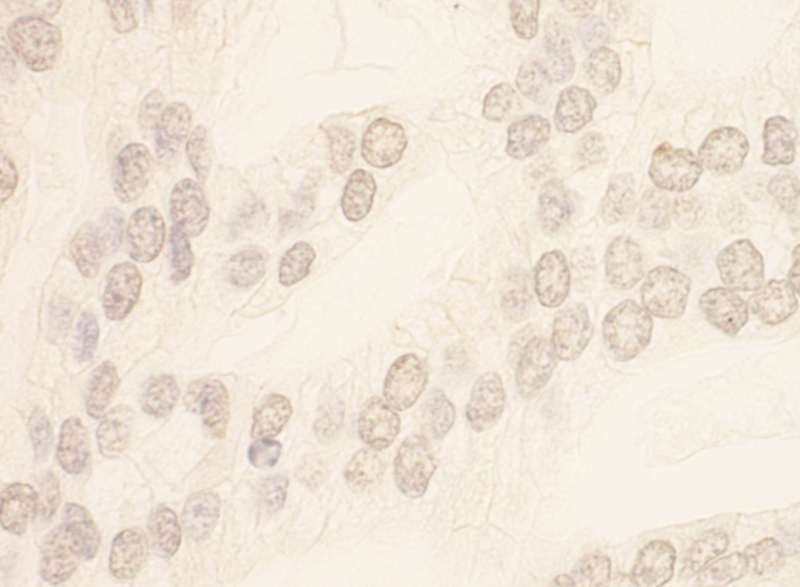 Detection of Human TMEM131L by Immunohistochemistry. Sample: FFPE section of human prostate carcinoma. Antibody: Affinity purified rabbit anti-TMEM131L used at a dilution of 1:1000 (1 ug/ml). Detection: DAB.